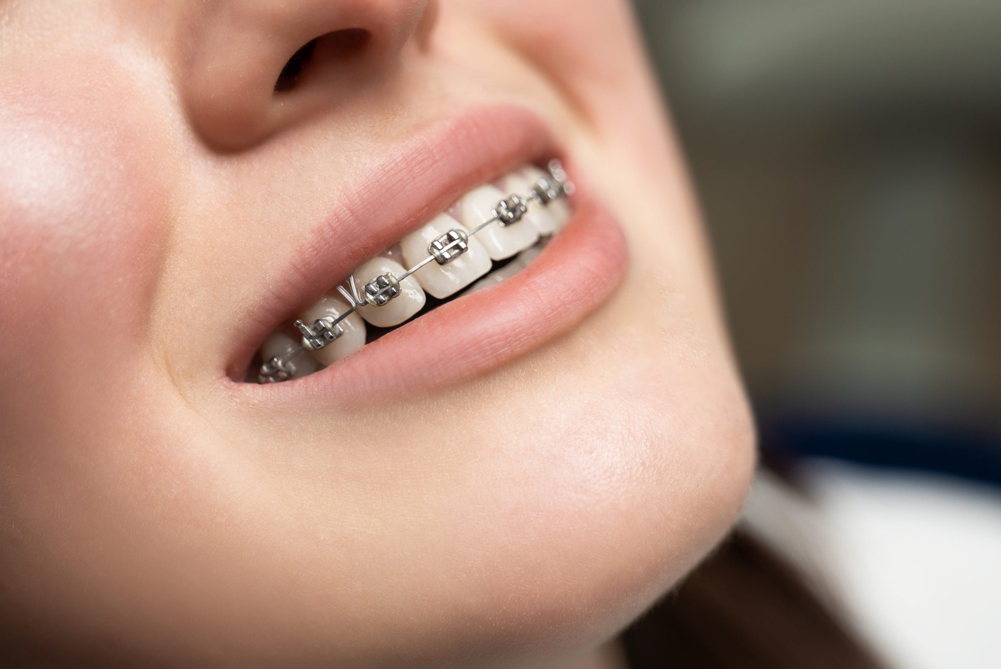 Why do I need braces?