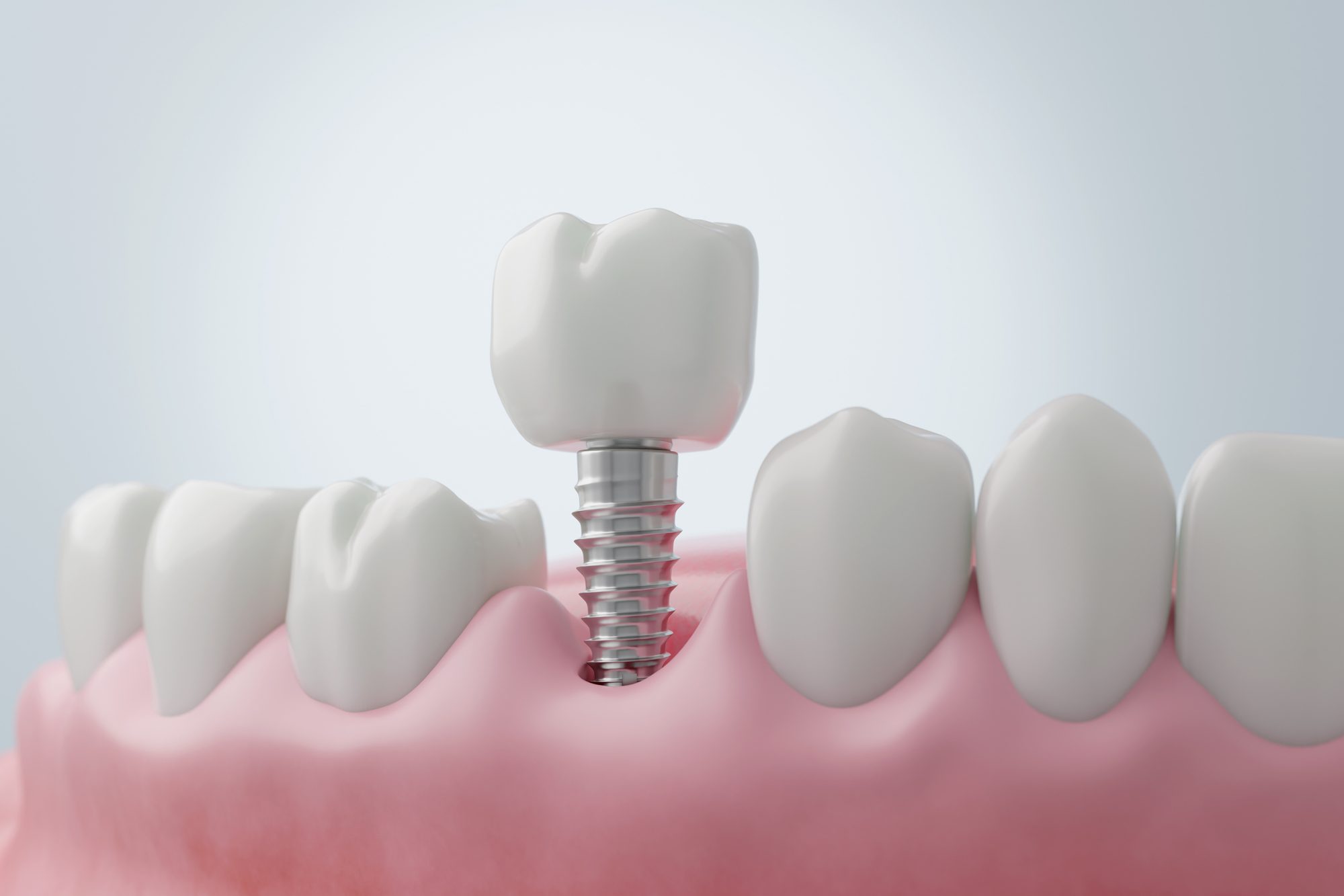 Dental Implant - A solution to replace your missing teeth