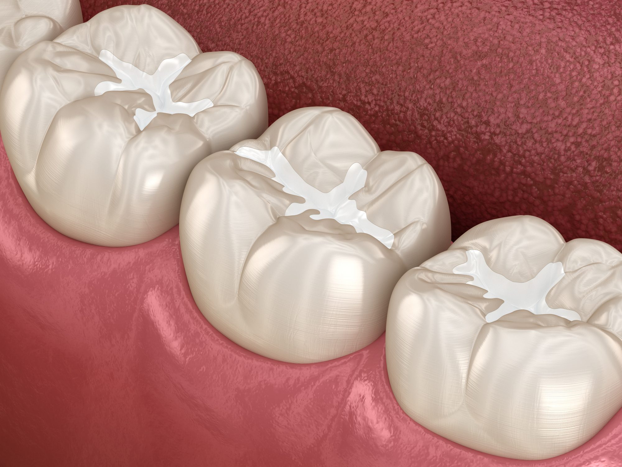 Dental Sealant - A Safeguard from Decay