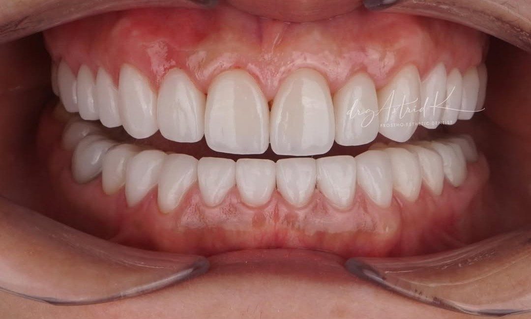 After treatment