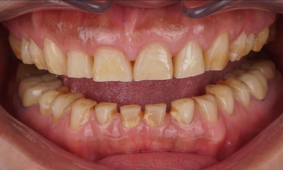 Before treatment