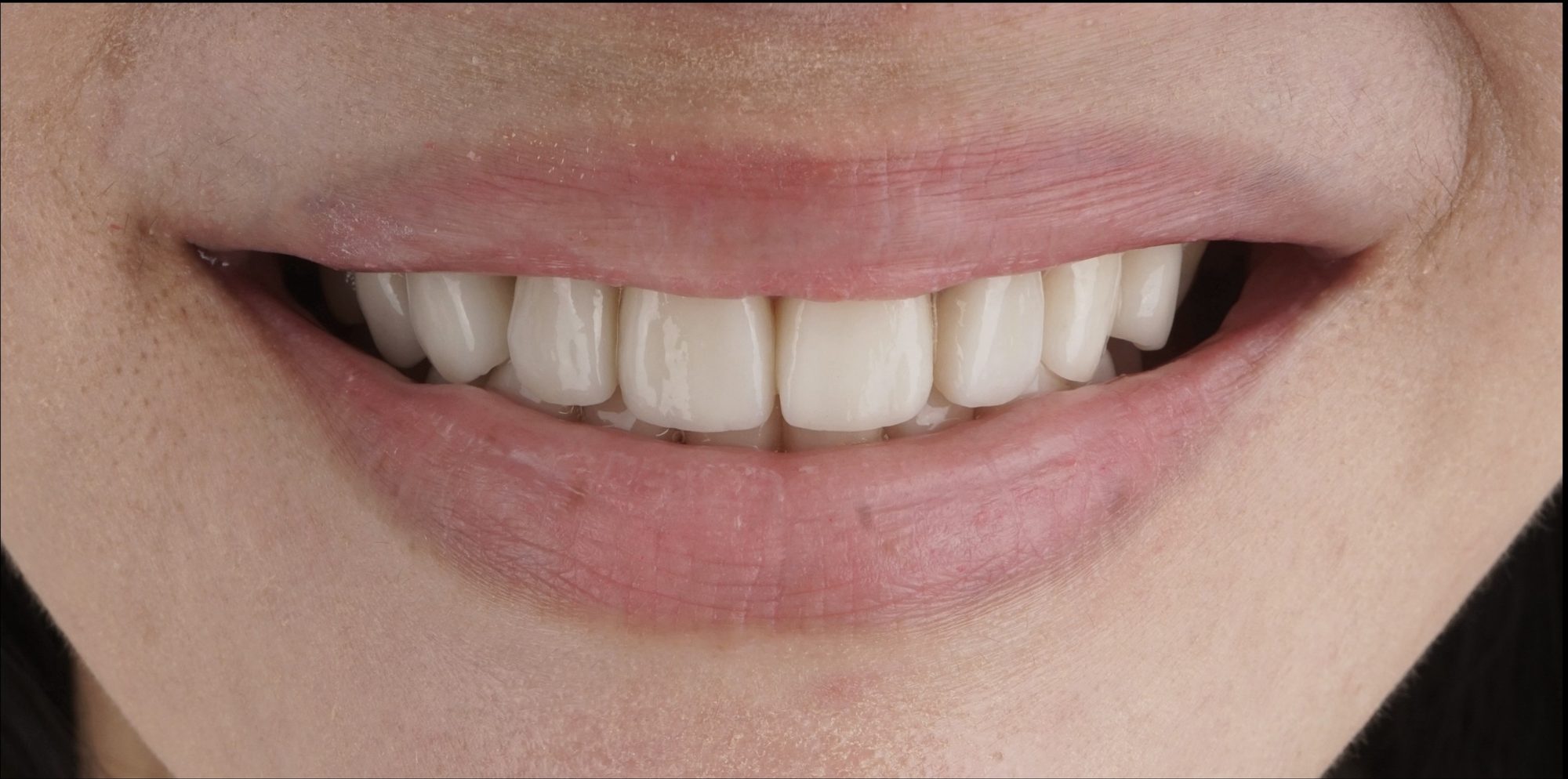 Before treatment