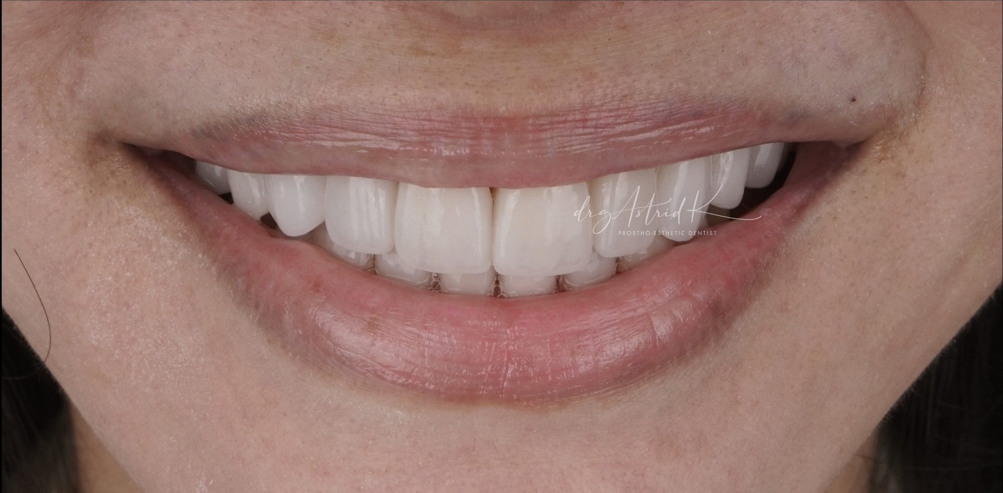 After treatment